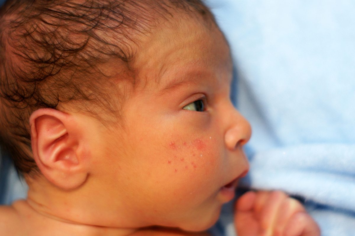 brufoli neonato